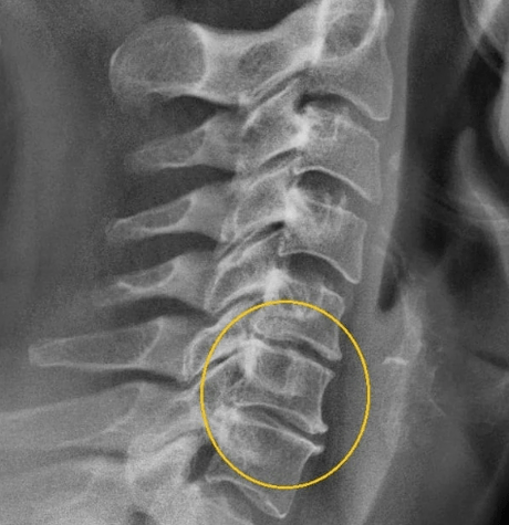 zerbikaleko osteokondrosia