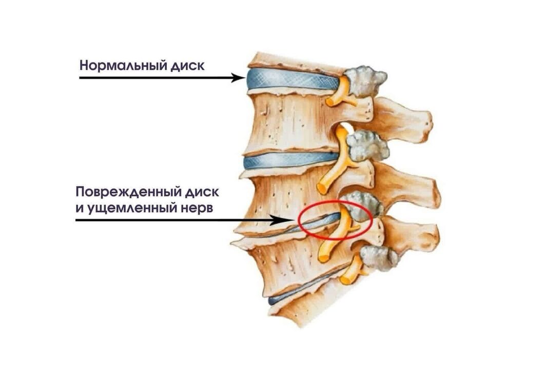 Trápaga osteokondrosiaren sintomak