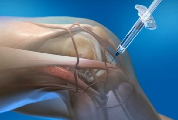 artikulazio barruko injekzioak belauneko artikulazioaren artrosi baterako