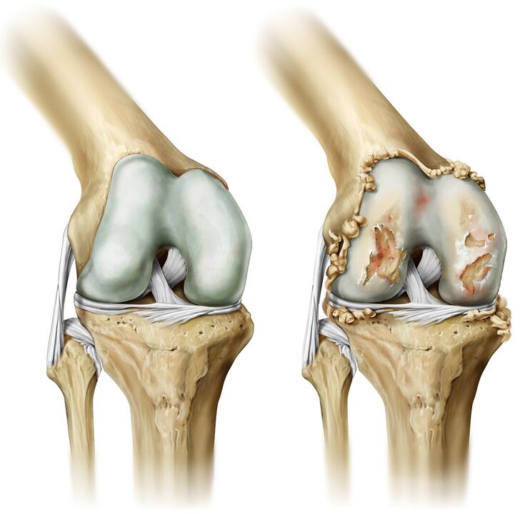artritisa suntsitutako artikulazioak